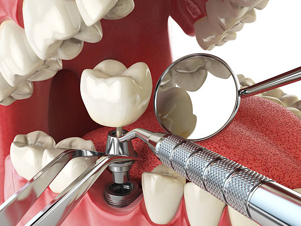 Best Emergency Treatment for Dental Infections or Abscesses in Lorena, TX